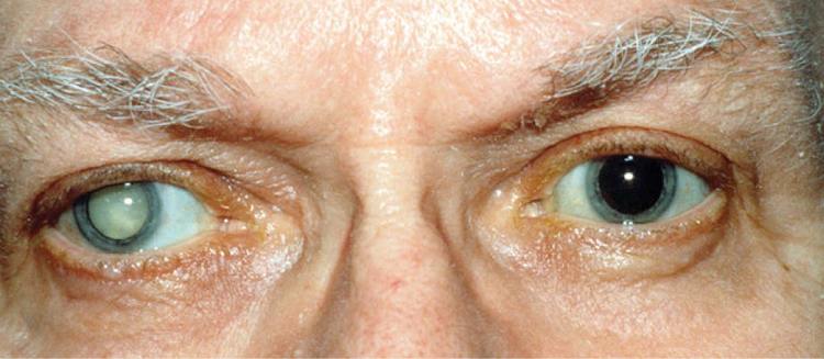 Лечение перезрелой катаракты лучше проводить под наблюдением врача.