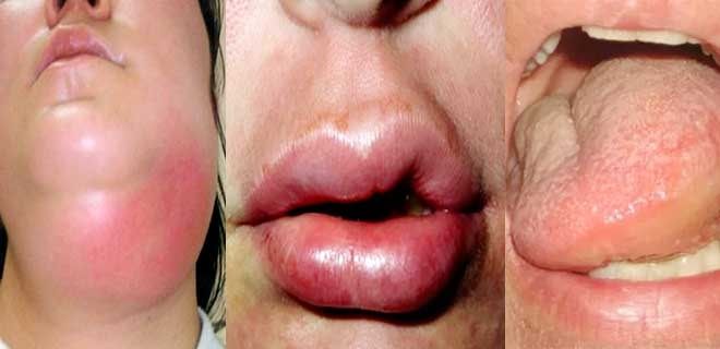 Опухший язык, губы, мягкие ткани горла