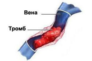 Что такое тромбоз глубоких вен в ногах, почему отрывается тромб и чем это грозит