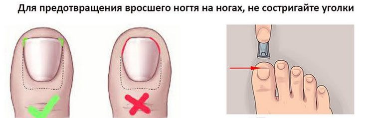 В целях профилактики очень важно правильно состригать ногти.