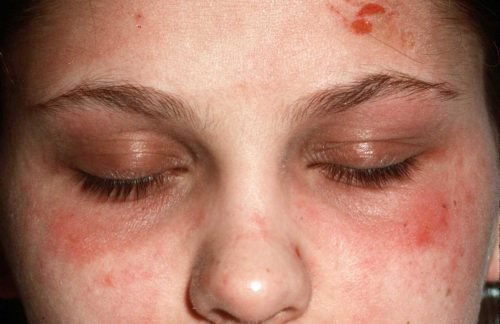 Атопический дерматит на лице