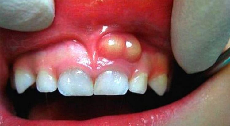 Лечение флюса на десне должно начинаться с посещения стоматолога.