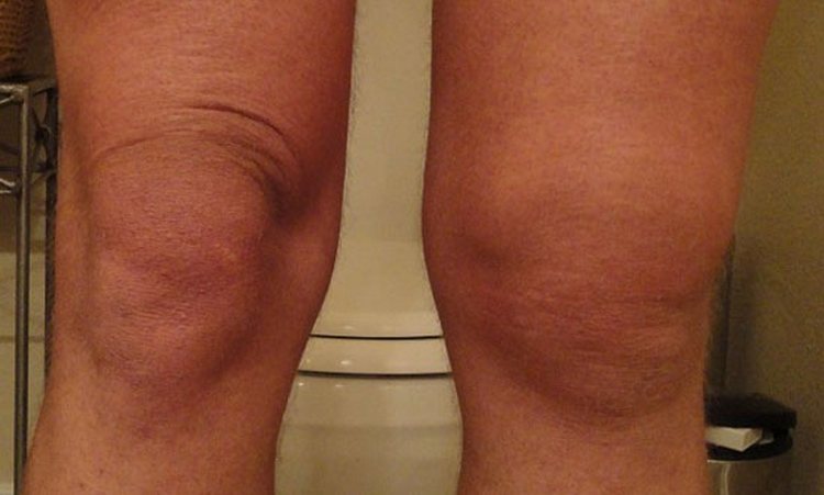 Поговорим о лечении синовиальной жидкости в коленном суставе.