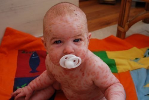 Младенец с мастоцитозом
