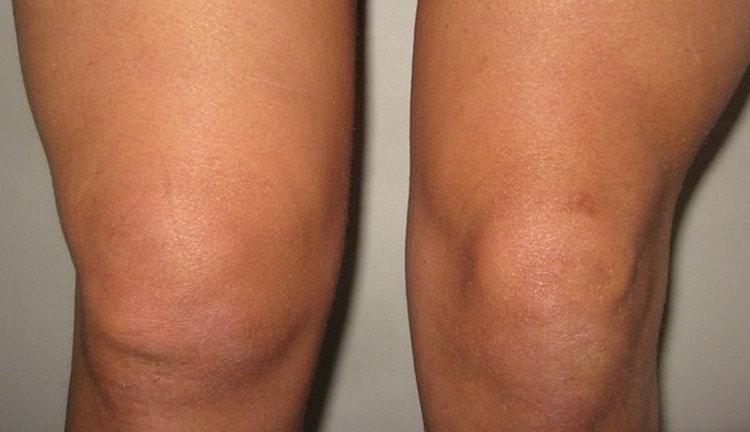 Жидкость в коленном суставе может накапливаться из-за сильной травмы.