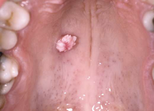 Папиллома плоскоклеточная во рту