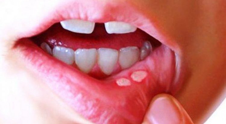 На фото видны требующие лечения язвочки во рту, которые могут быть спровоцированы разными причинами.