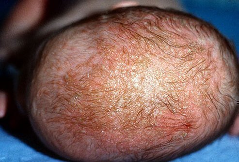 Себорейный дерматит у младенца