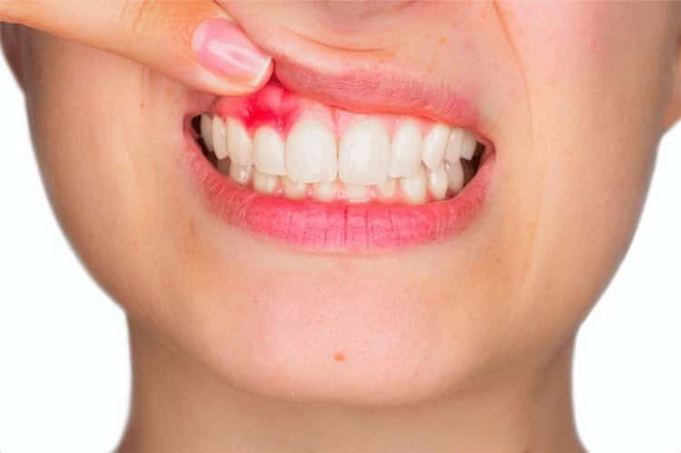 киста зуба симптомы лечение и последствия