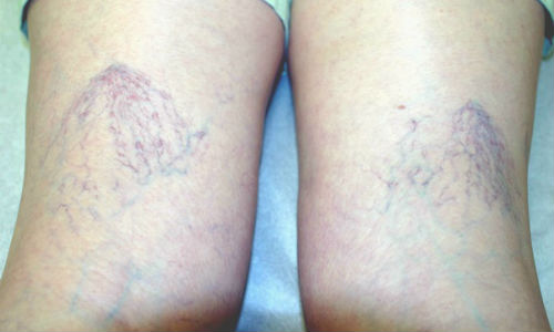 Причины появления и лечение варикозных звездочек на ногах