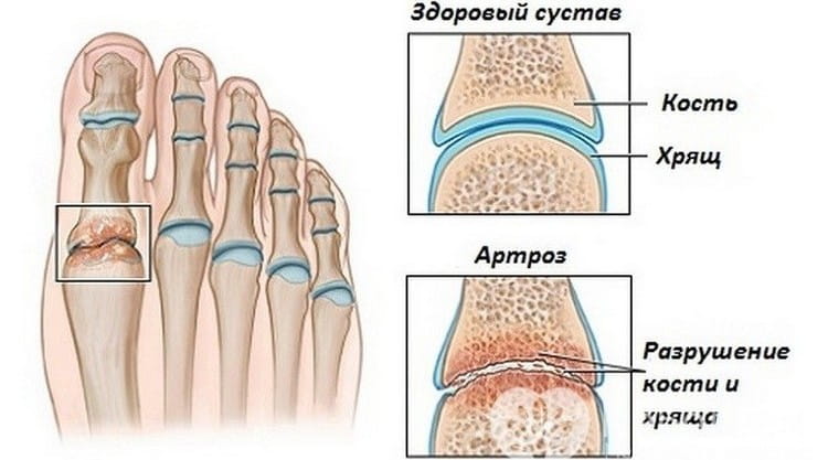 На рисунке видны симптомы артроза суставов стопы, которые требуют лечения.