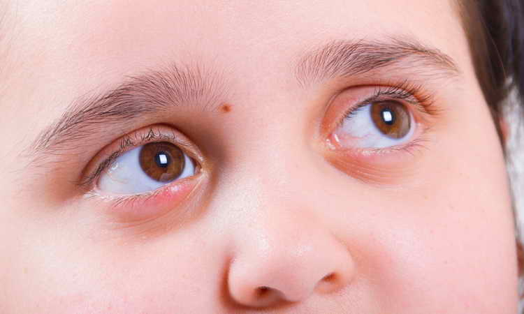 лечение блефарита у детей