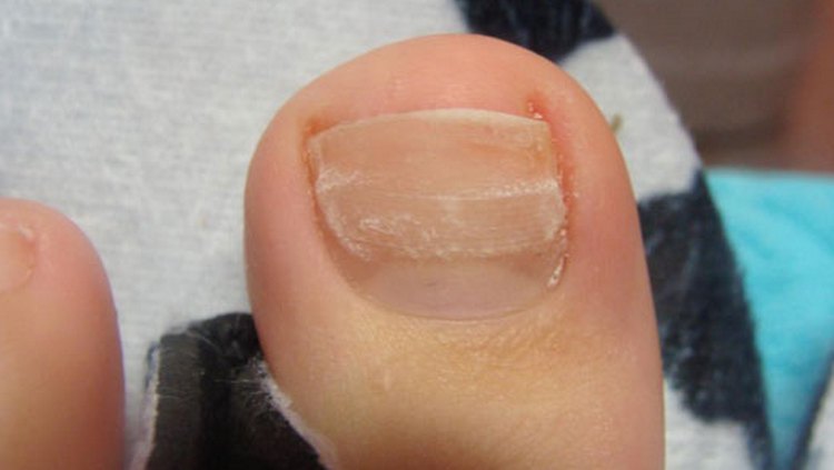 Узнайте, каким должно быть лечение в домашних условиях, если нарывает палец на ноге возле ногтя.