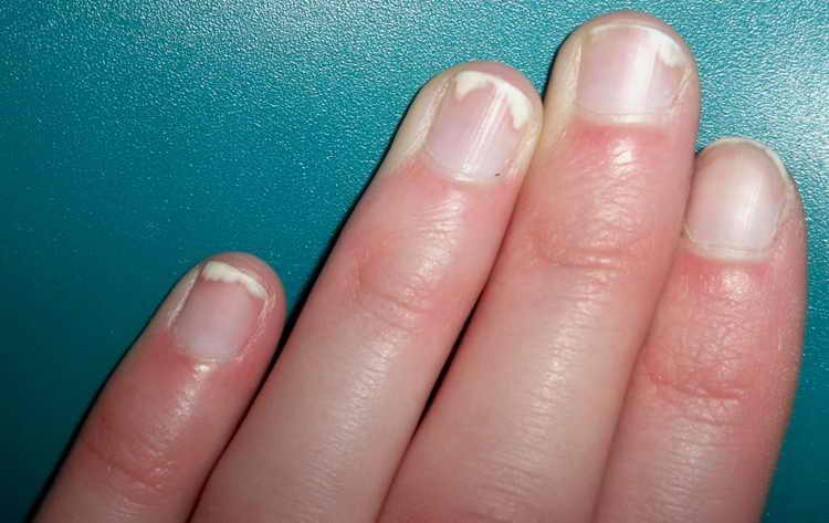 псориаз ногтей симптомы лечение