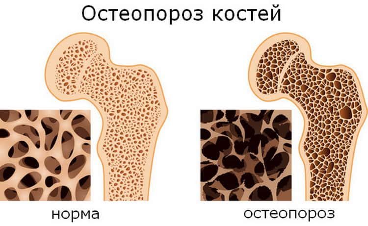 Остеопороз: симптомы и лечение народными средствами в домашних условиях
