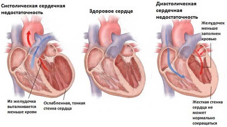 как укрепить сердечную мышцу