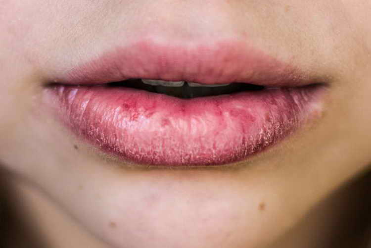 почему трескаются уголки губ причины и лечение