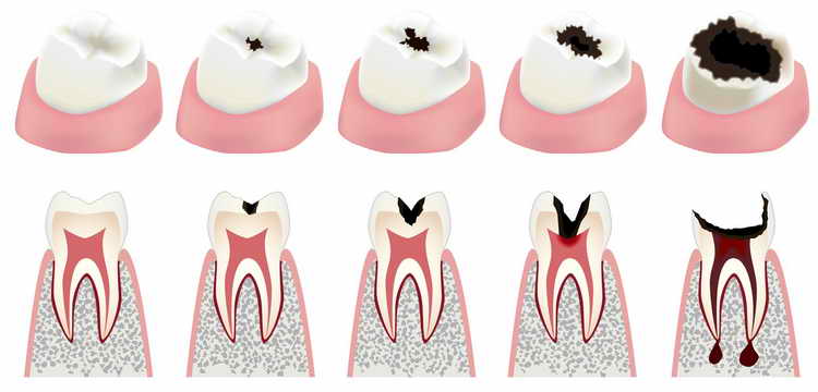 лечение кариеса зубов дома