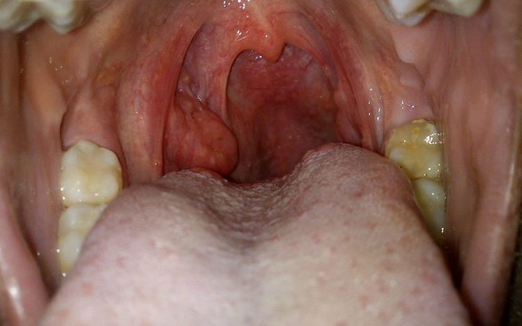 Заболевание может быть спровоцировано проблемами с горлом. например, хроническим тонзиллитом.