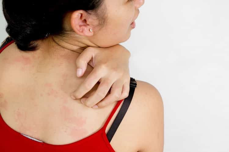 Как лечится аллергия на коже