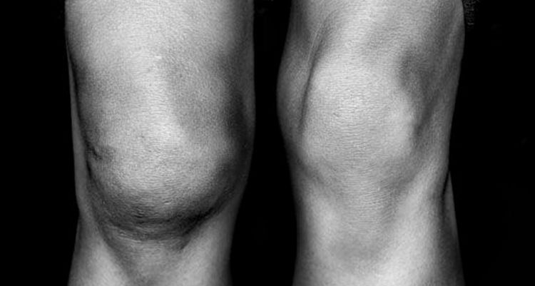 Среди симптомов повреждения мениска коленного сустава можно отметить хруст при ходьбе, трудности при сгибании ноги, боль, даже отечность.