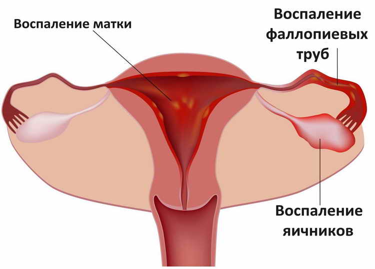воспаление эндометрия матки симптомы лечение