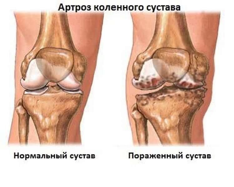 артроз коленного сустава лечение в домашних условиях