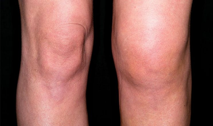 Гонартроз коленного сустава второй степени требует незамедлительного лечения.