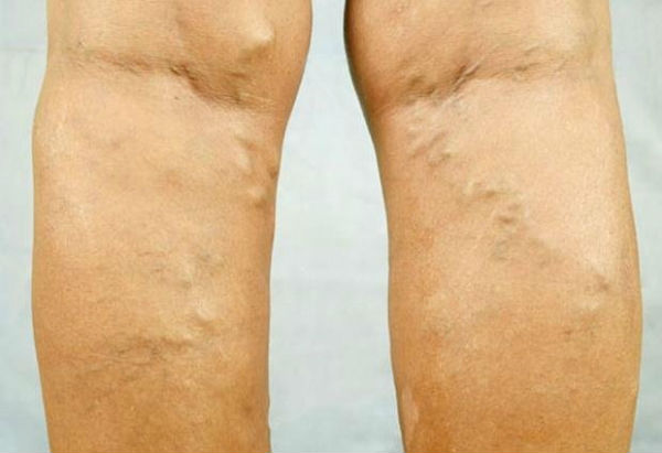 варикоз у мужчин на ногах фото