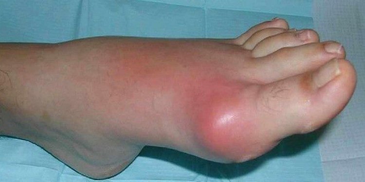 На фото отчетливо видны симптомы подагрического артрита стопы, требующие лечения.