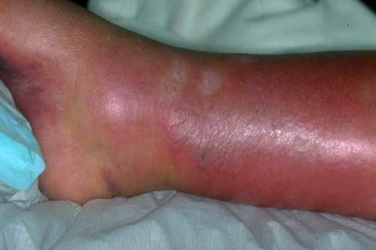 лечение рожистого воспаления ноги в домашних условиях