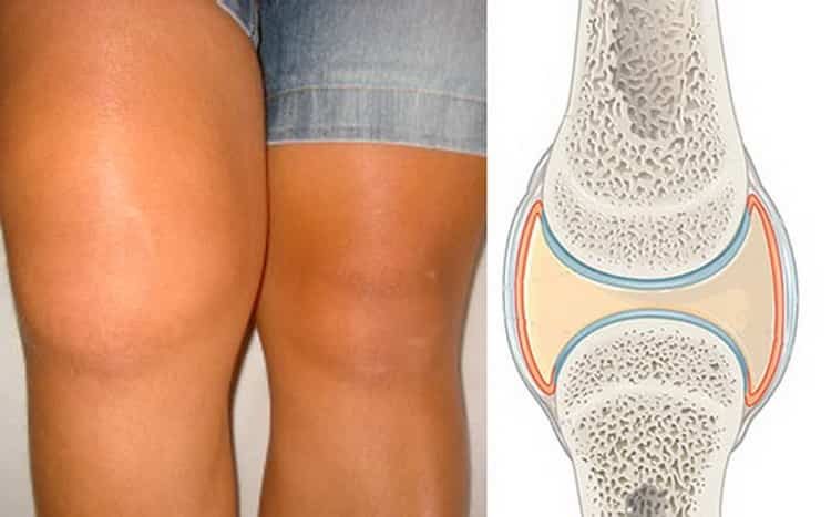 синовит коленного сустава симптомы лечение