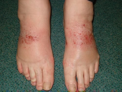Как выглядит дерматит на ногах фото у взрослых