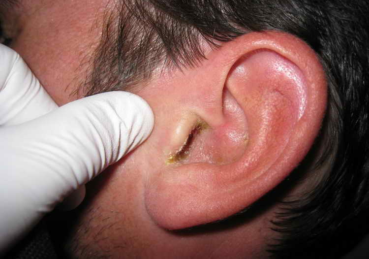 Воспаление среднего уха