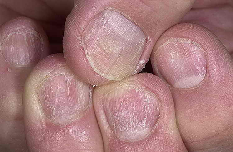 псориаз ногтей лечение причины