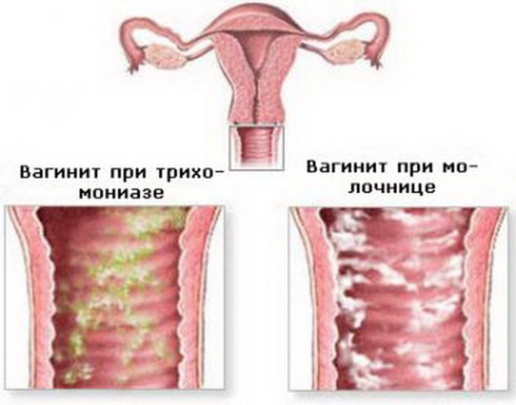 вагинит: лечение и профилактика