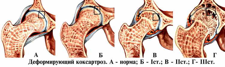 коксартроз тазобедренного сустава 1 степени