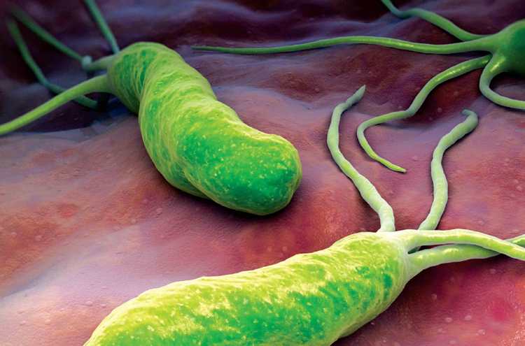 Язва двенадцатиперстной кишки нередко бывает спровоцирована бактерией хеликобактер пилори.