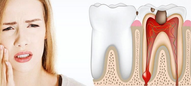 пульпит зуба лечение