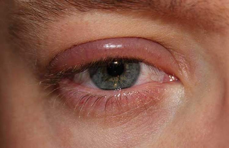 Требуют лечения симптомы аллергии на глазах.