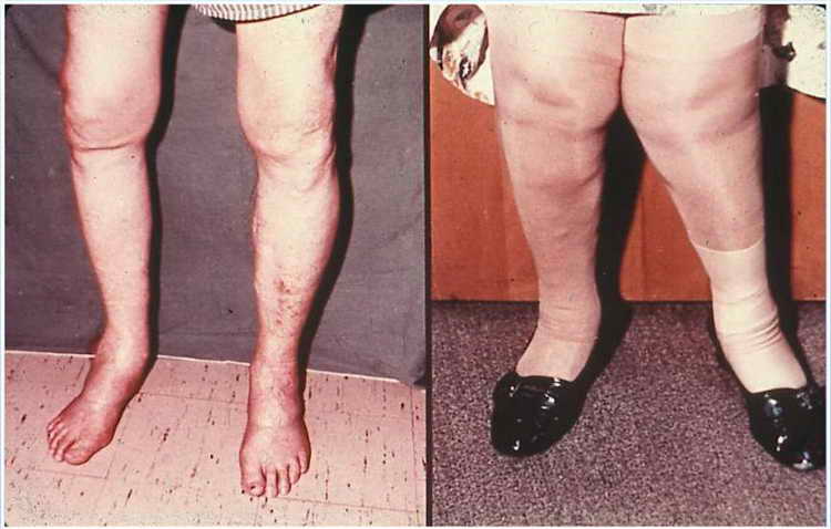 деформирующий остеоартроз коленного сустава 2 степени причины