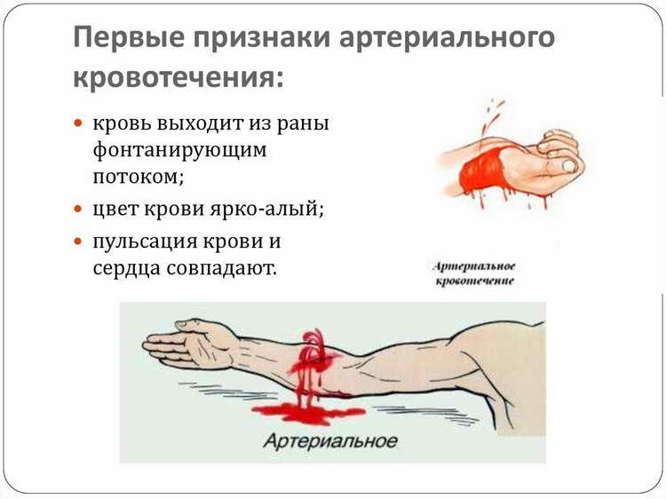 первая помощь при артериальном кровотечении