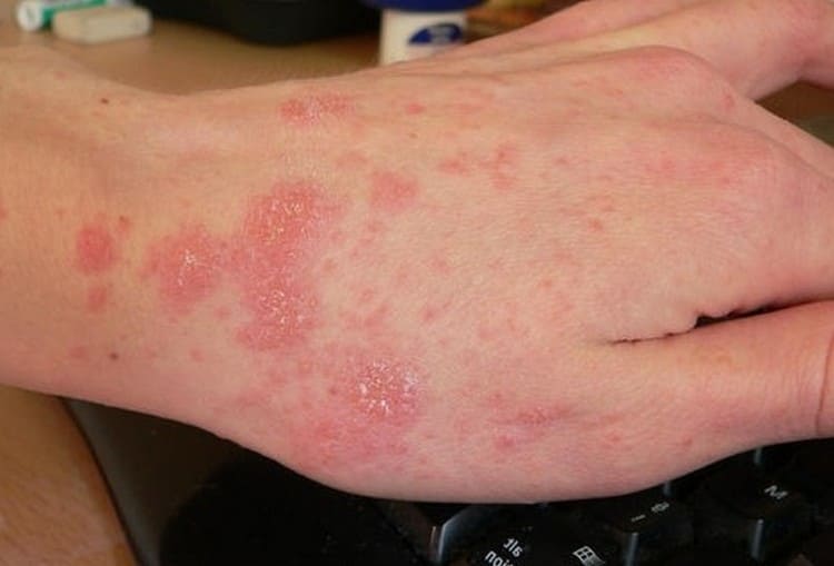 Требуют лечения и неприятные симптомы холодовой аллергии.