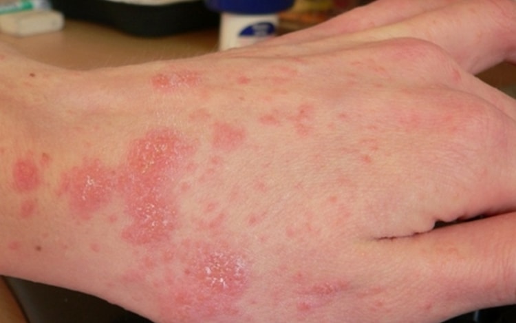 Лечебные свойства вяза чаще всего применяются для лечения кожных заболеваний.
