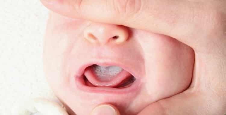 Молочница у детей во рту: причины, симптомы и лечение народными средствами в домашних условиях