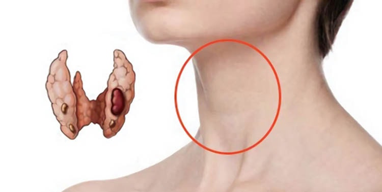 От проблем со щитовидной железой поможет осока