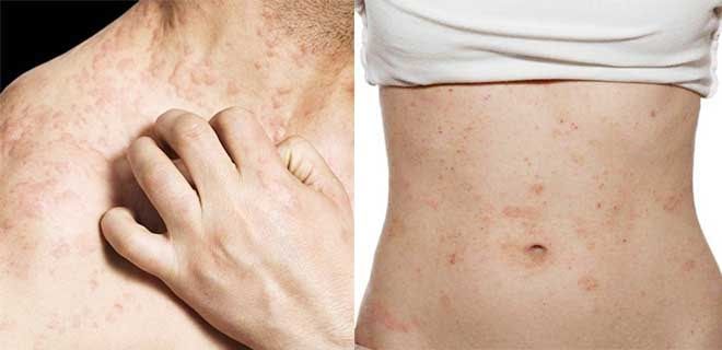 Симптомы аллергии на коже