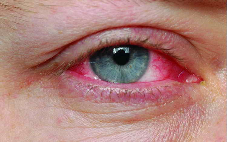 красные глаза причины и лечение