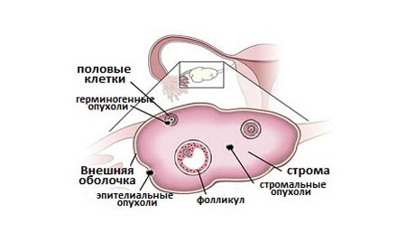 Виды опухолевых образований