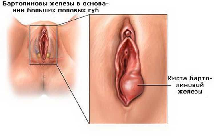 шишка на половой губе: советы по лечению